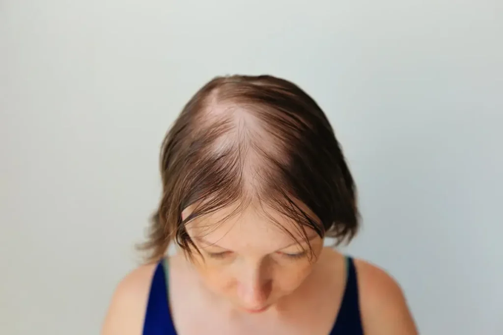 Causes and Diagnosis of Androgenetic Hair Loss in Females