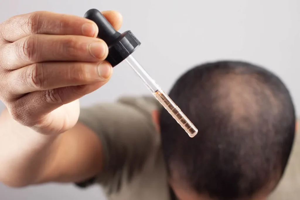Is Minoxidil Safe? Side Effects and Risks Explained