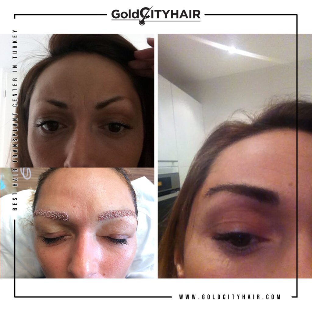 Facial Redness: Amazing Laser Therapy Fix