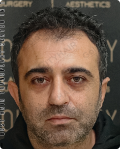 Understanding Hypertrophic Chest Scars and Keloids