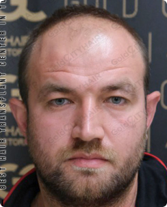 Understanding Alopecia Areata and Its Prevalence