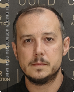 Biological Mechanisms Behind Alopecia Itching Scalp