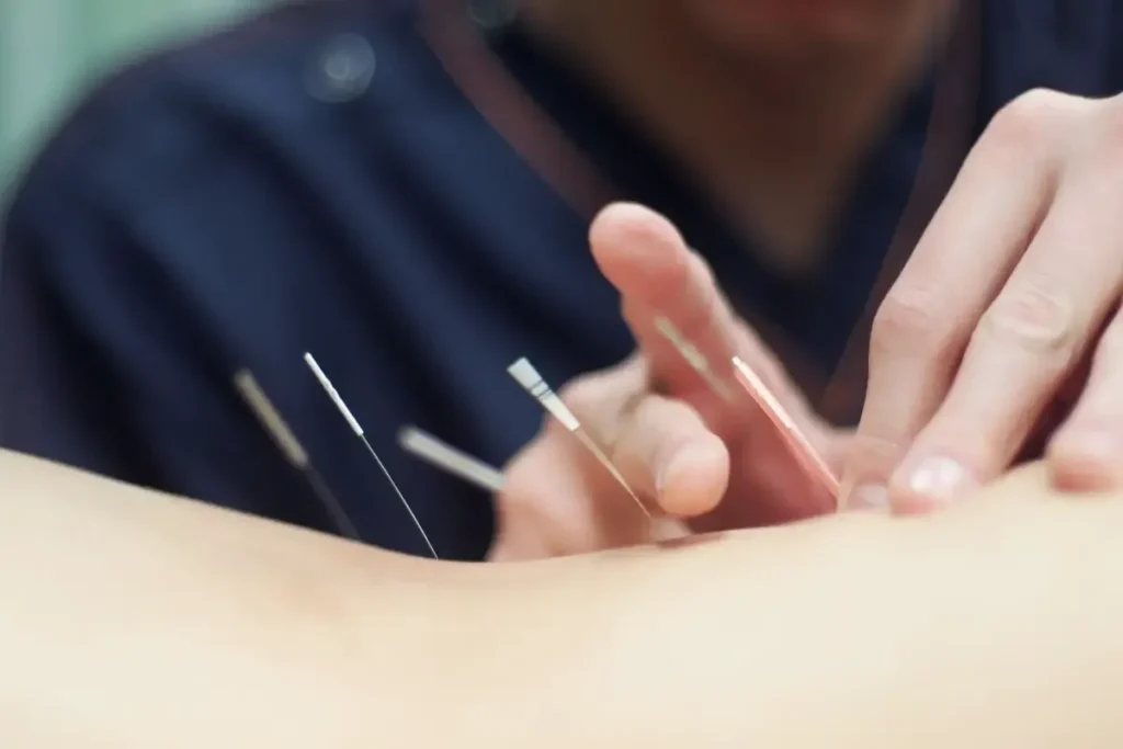 Aching After Acupuncture: Is It Normal Healing?
