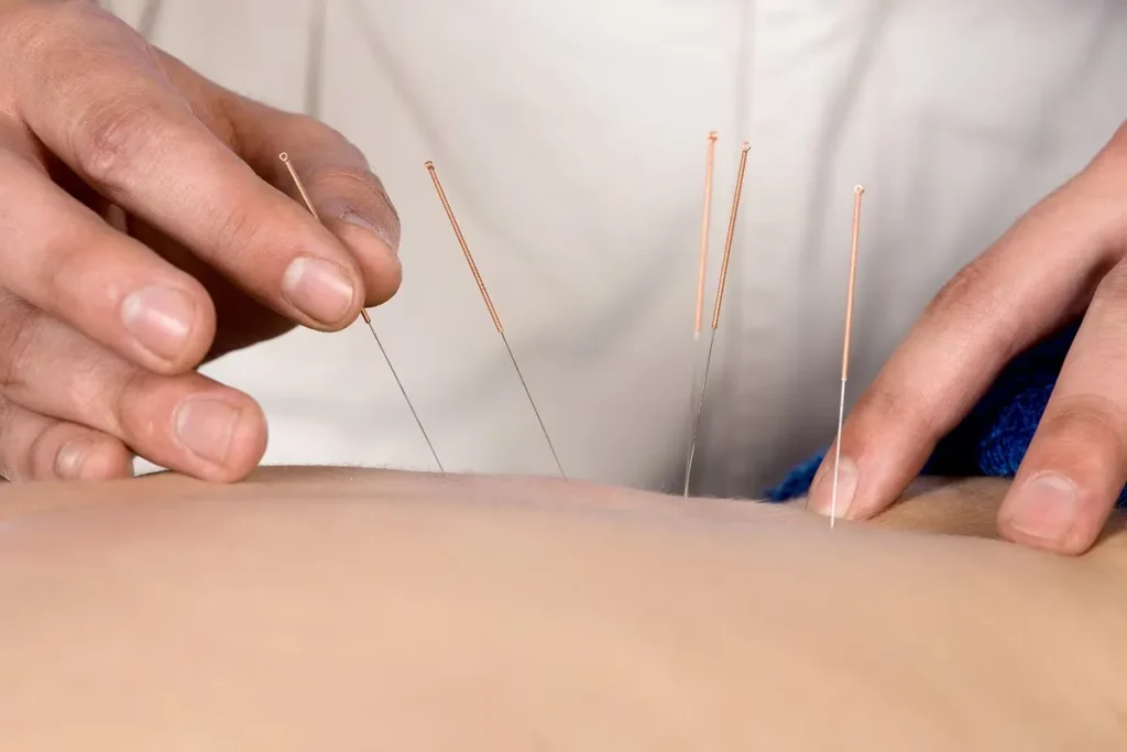 Acupuncture Aftercare: Brilliant Tips For Healing