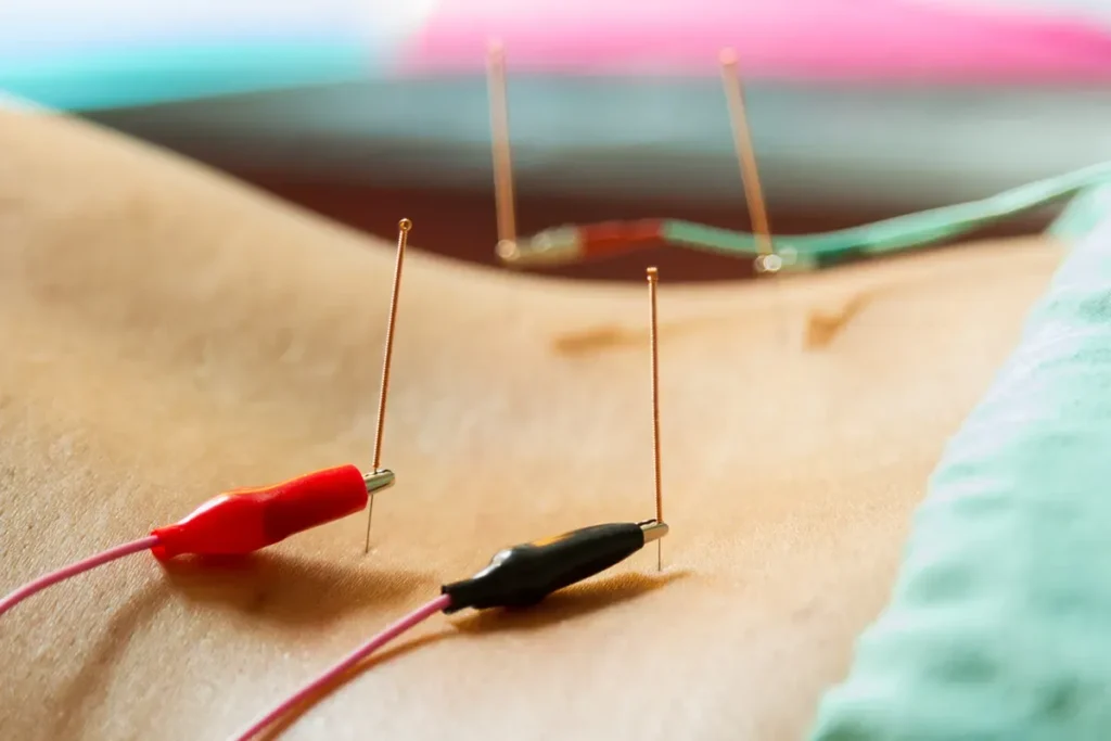 Acupuncture And Electricity: Bold Modern Healing
