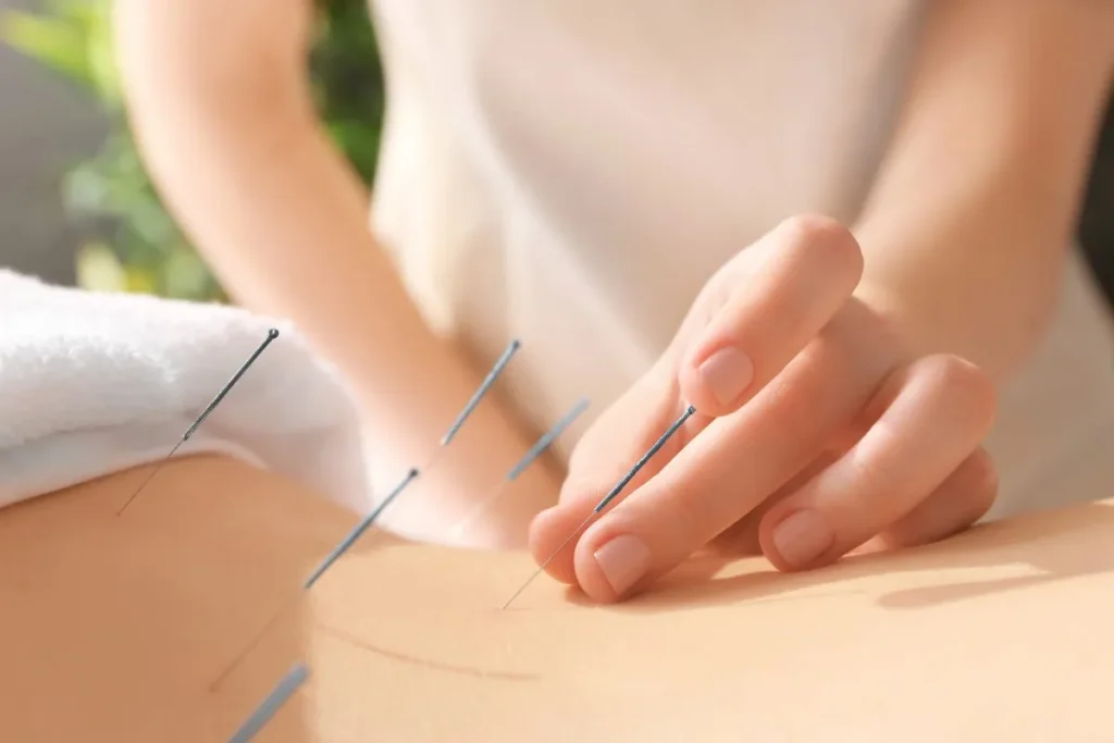 Acupuncture And Ivf: Proven Results For Moms