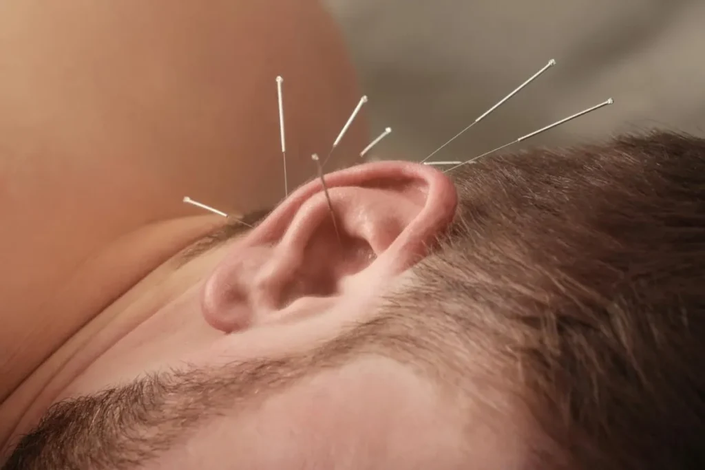 Acupuncture Ear: Instant Relief For Pain