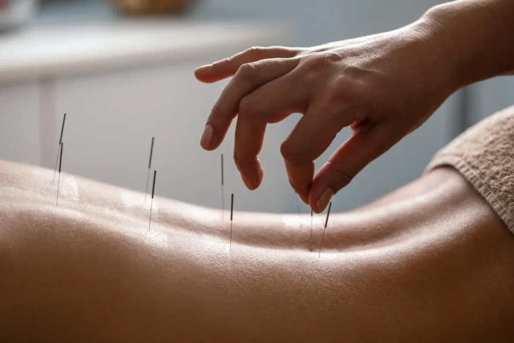 Acupuncture For Fertility Where Do Needles Go