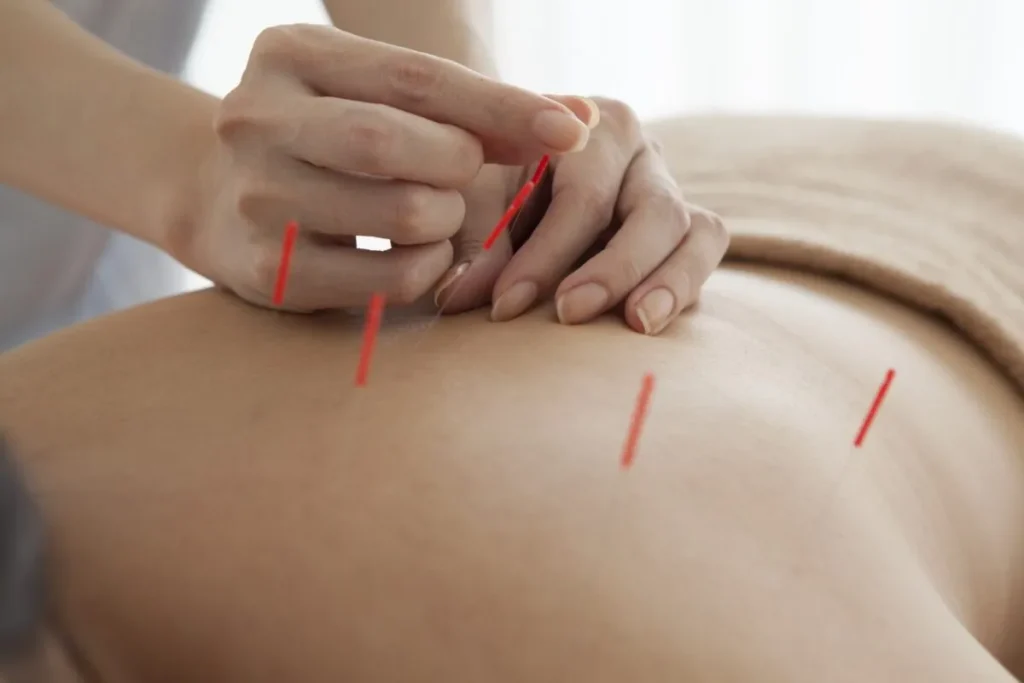 Acupuncture For Fertility Where Do Needles Go
