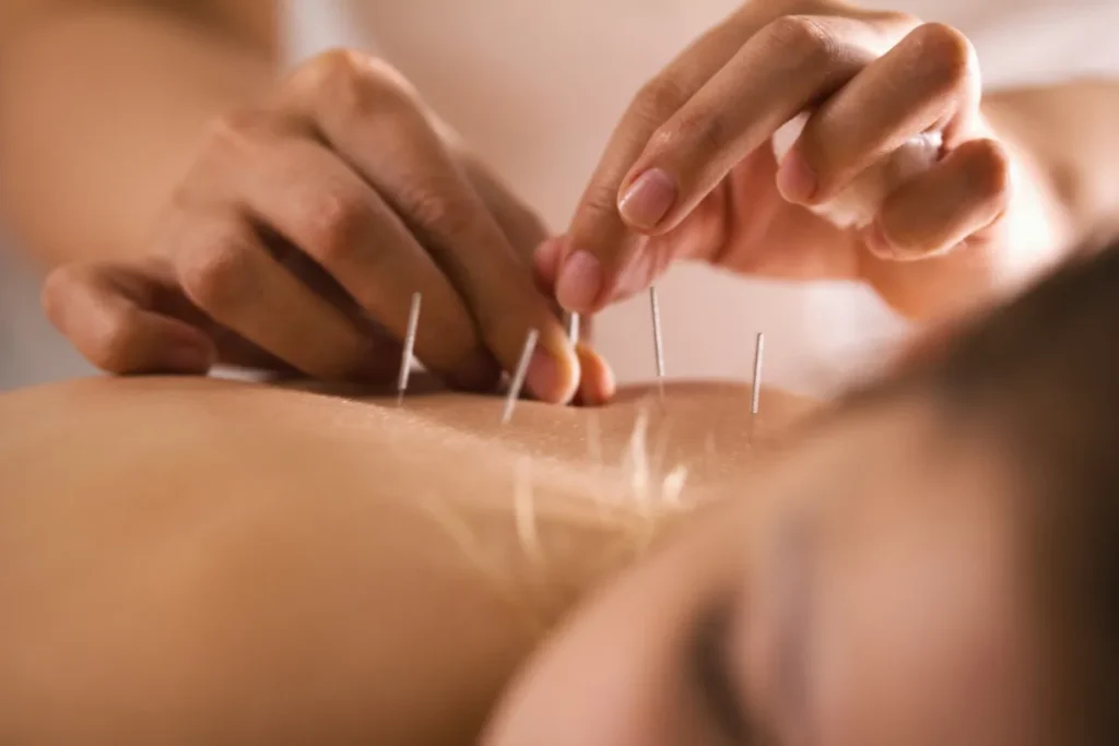 Acupuncture For Stress And Anxiety: Easy Cure