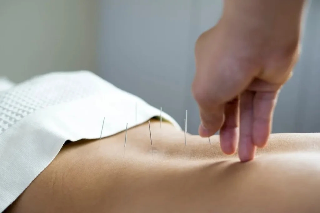 Acupuncture On Back: Amazing Relief Secrets