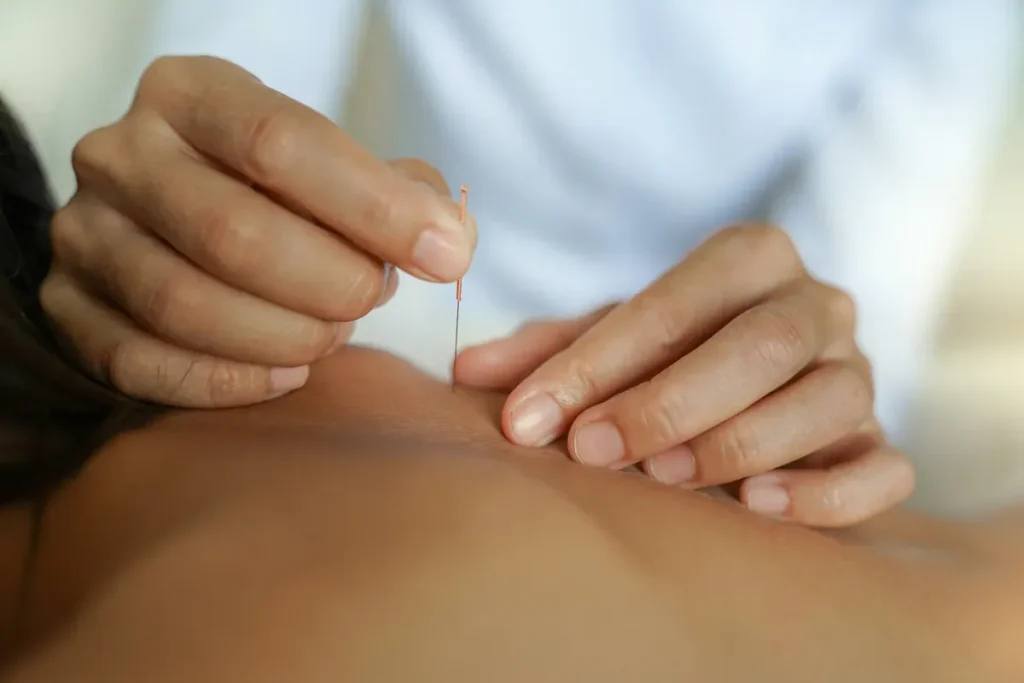 Acupuncture On Back: Amazing Relief Secrets