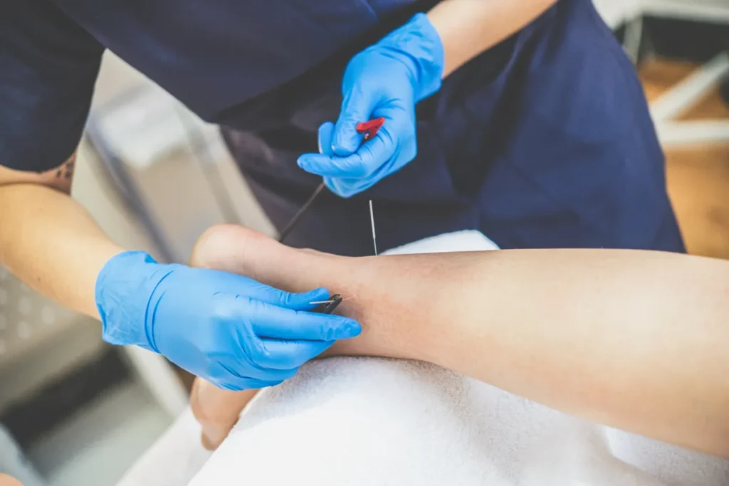 Acupuncture Points In Ankle: Rapid Recovery