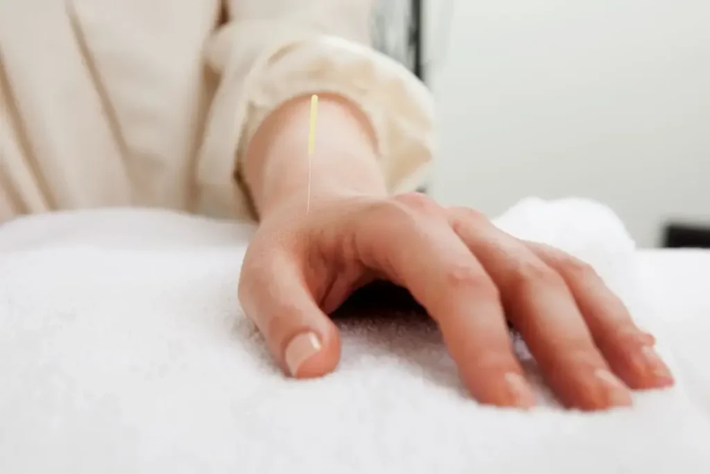 Acupuncture Stomach: Easy Digestion Relief