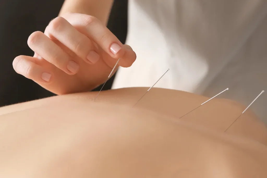 Acupuncture Stomach: Easy Digestion Relief