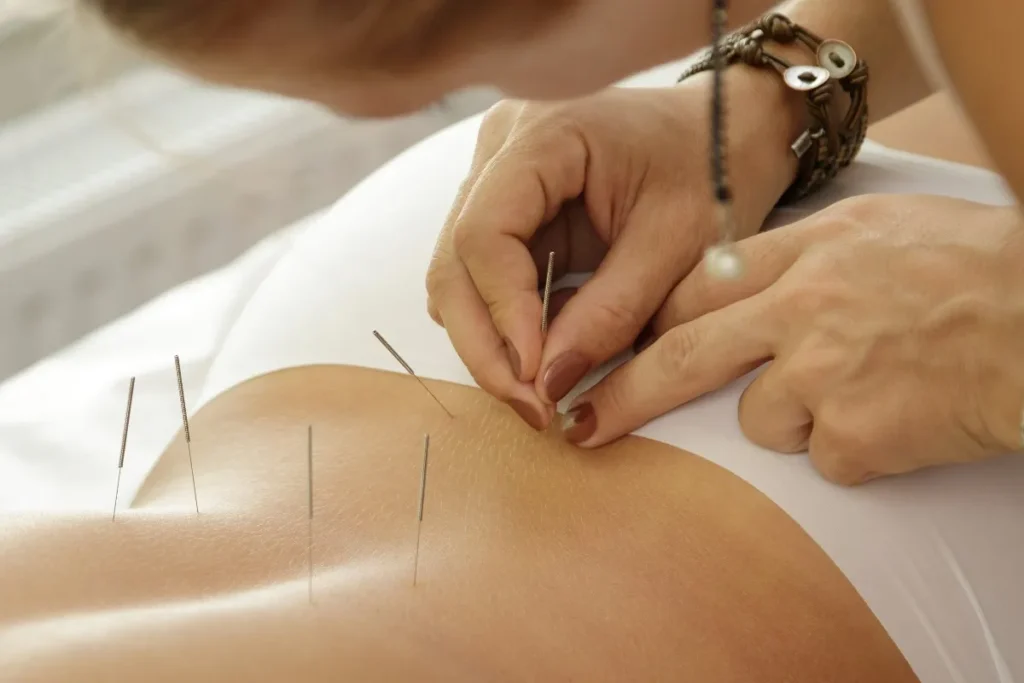Acupuncture Therapy For Fertility: Great Results