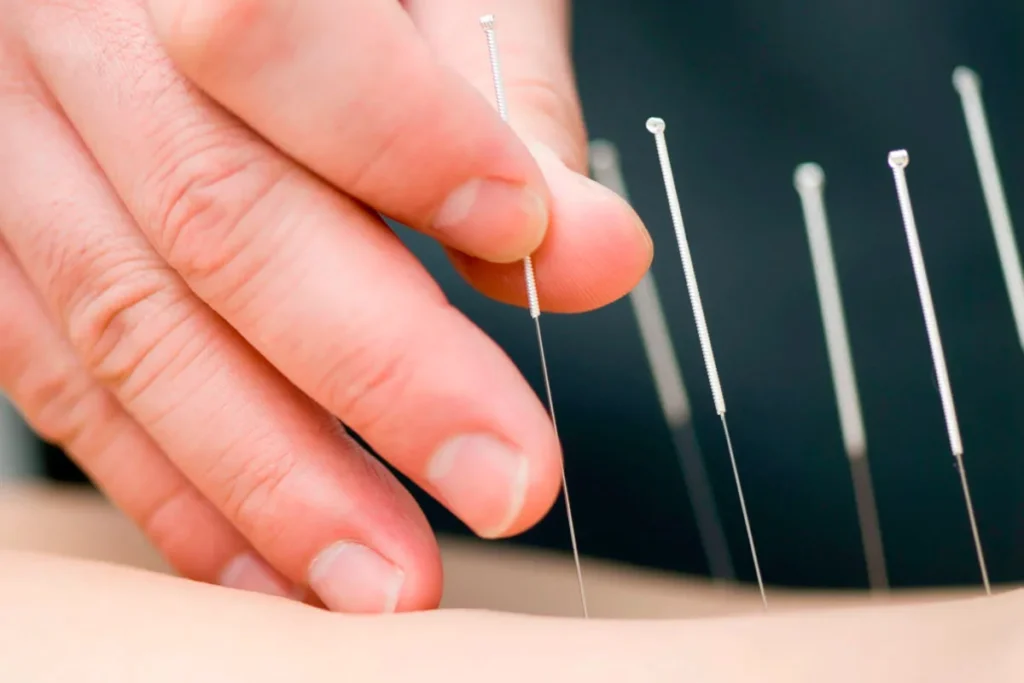 Acupuncture With Electrical Stimulation: Help