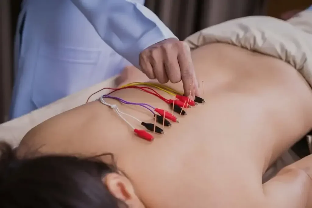 Acupuncture With Electrical Stimulation: Help