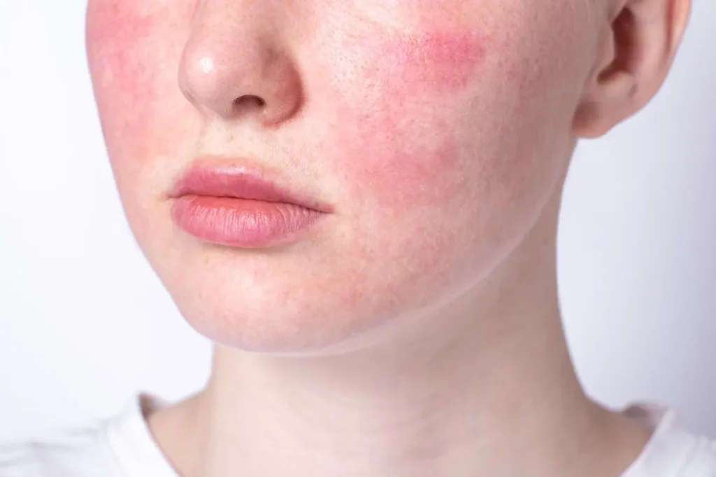 Alcoholism And Skin Sores: Painful Facts