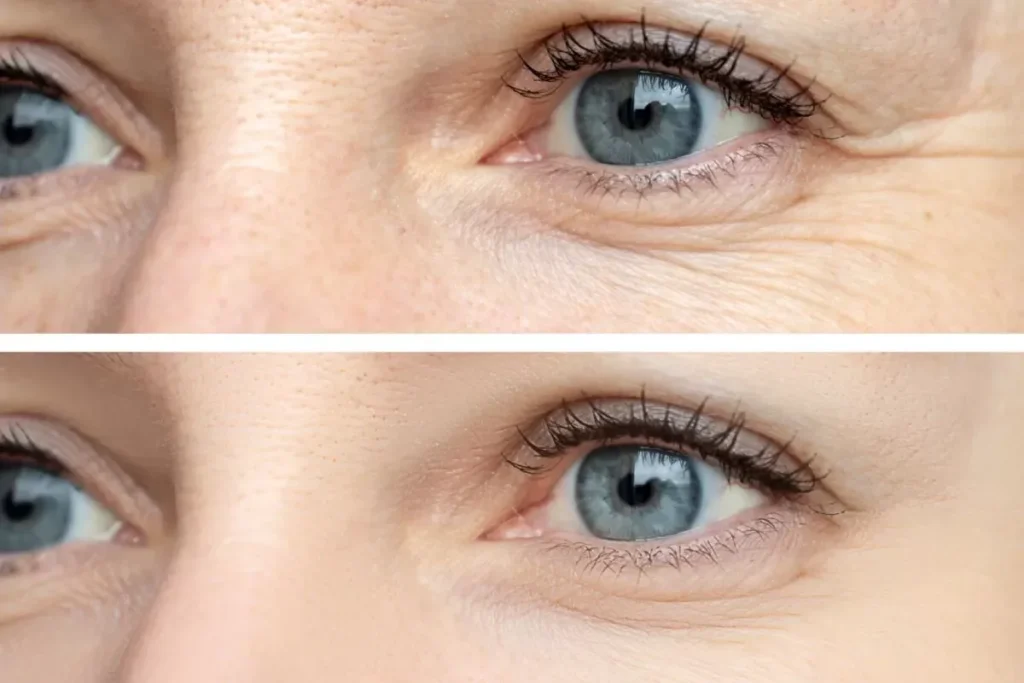 Understanding Under-Eye Wrinkles