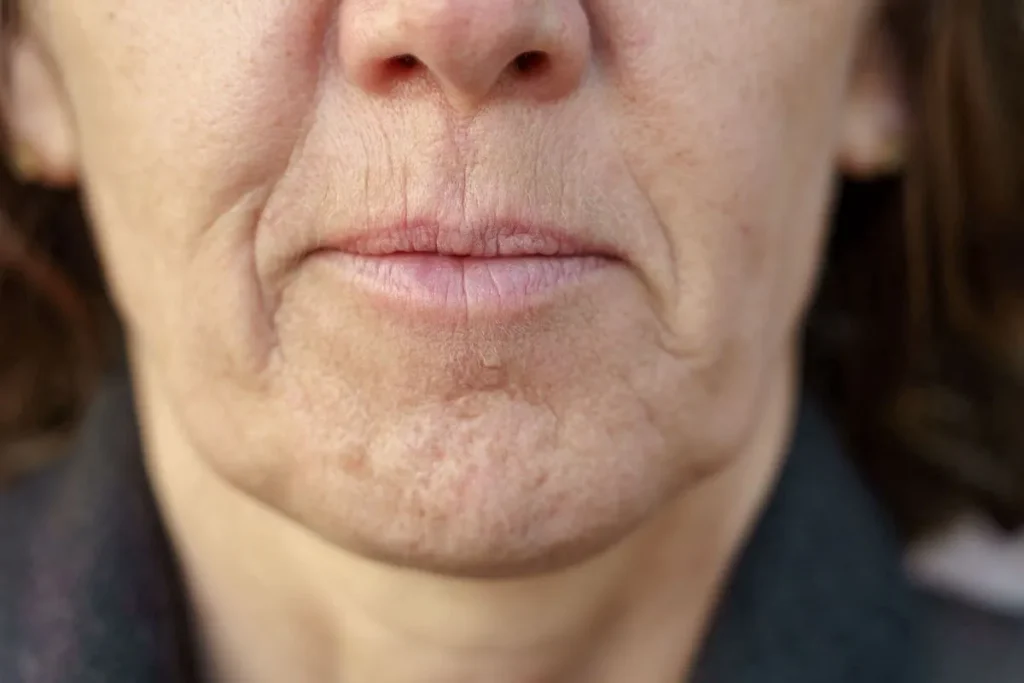 Chin Wrinkles Treatment: Amazing Youth Wins