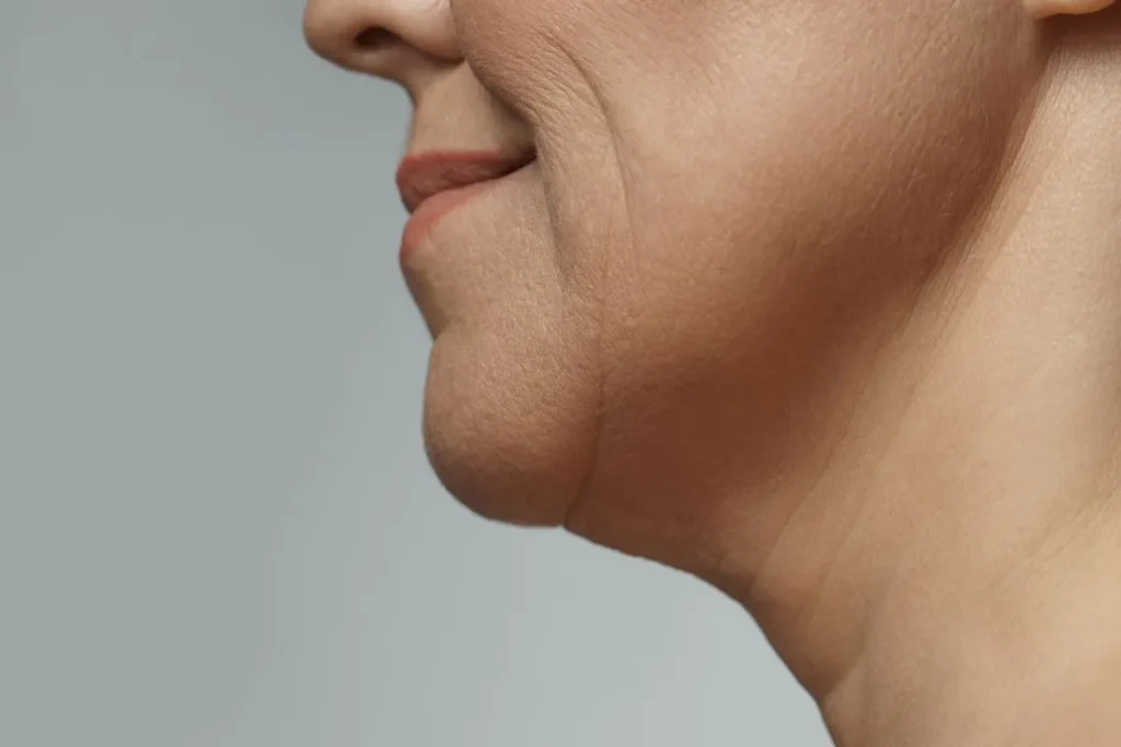 Chin Wrinkles Treatment: Amazing Youth Wins
