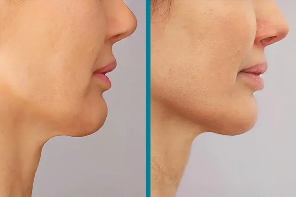 Co2 Laser Before And After Wrinkles: Win