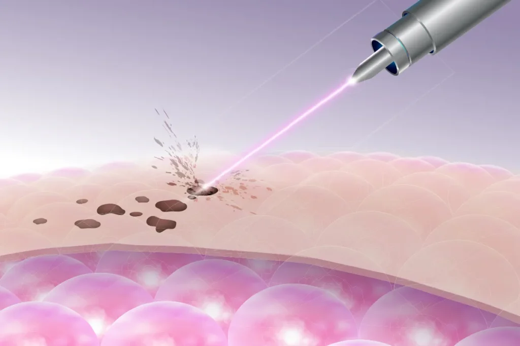 Co2 Laser For Scars: Powerful Quick Fixes