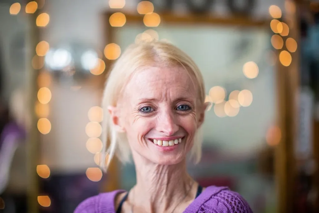 Fast Aging Disorder: Scary Facts And Hope