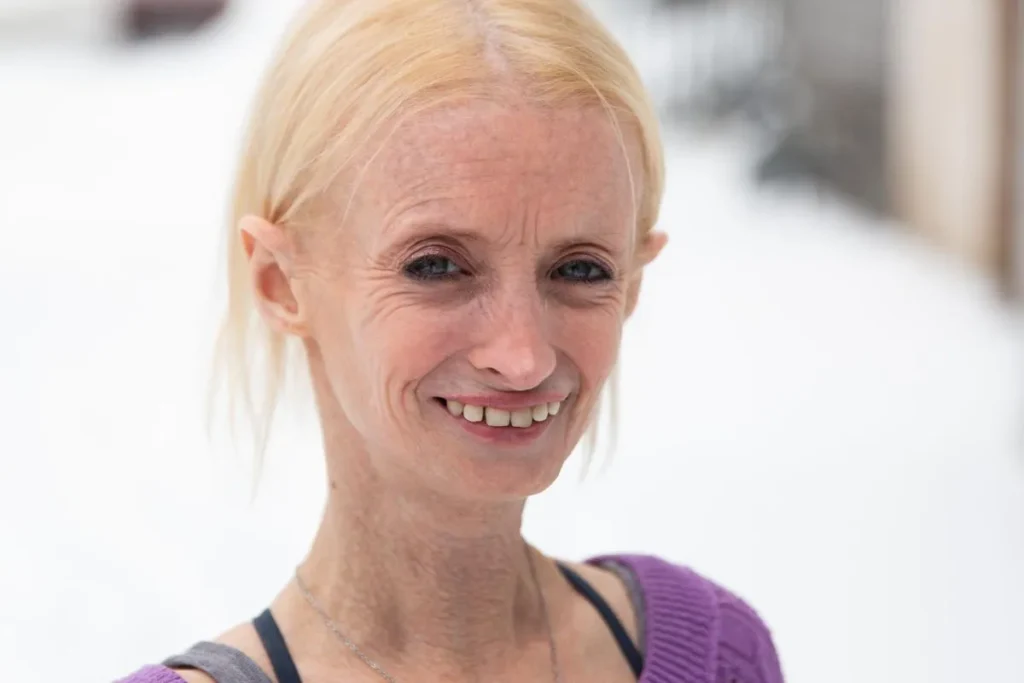 Fast Aging Disorder: Scary Facts And Hope