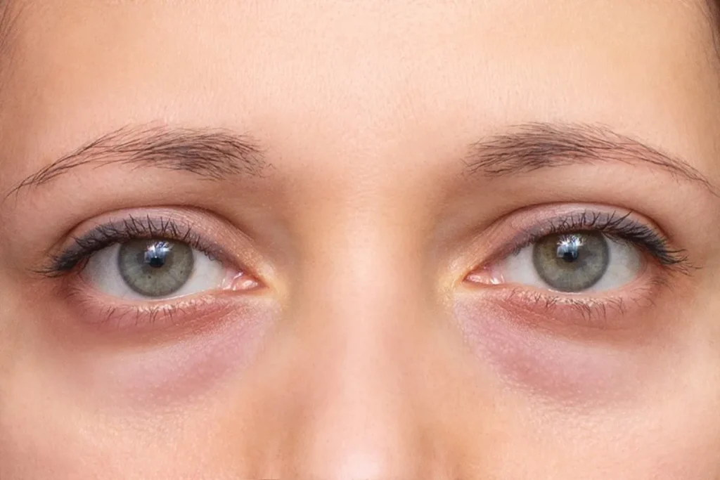 Fine Lines Around Eyes: Best Ways To Revitalize