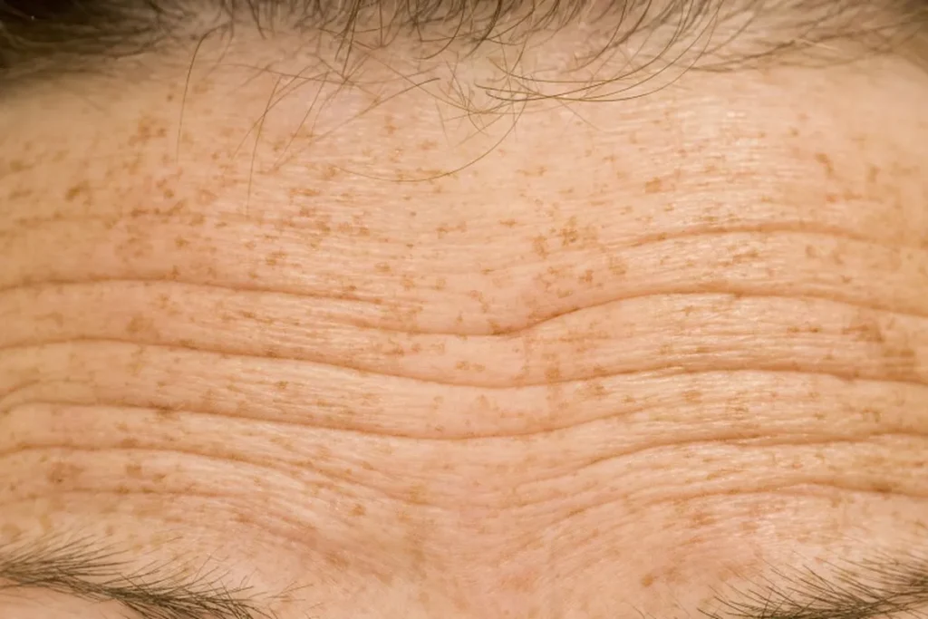Fine Lines On Forehead: Effective Ways To Smooth