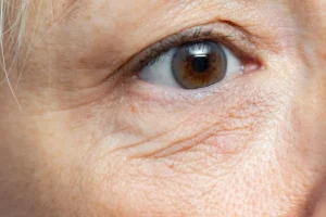 How Can I Remove Wrinkles Under My Eyes: Fast