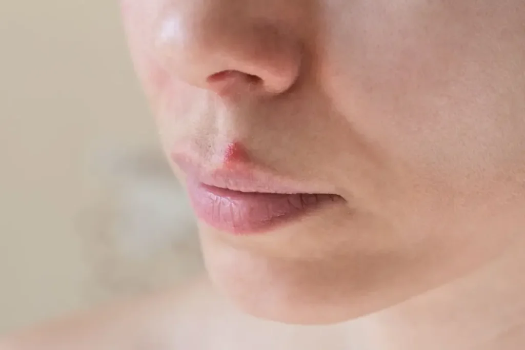 Meth Blisters Face: Scary Signs Of Addiction