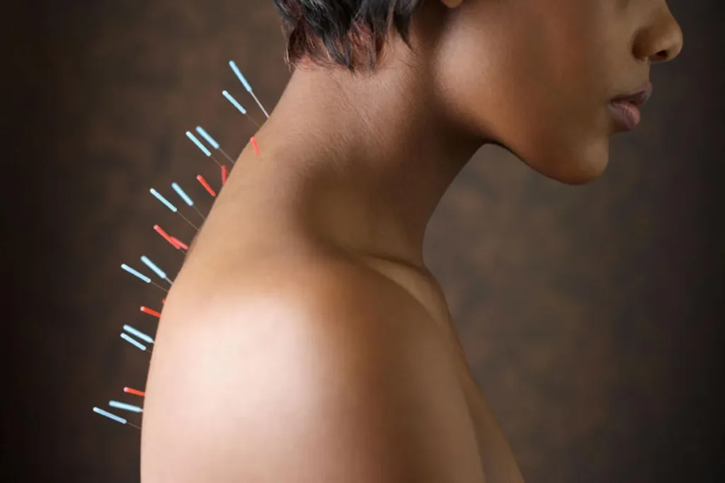 Neck Acupuncture Points Chart: Amazing Healing