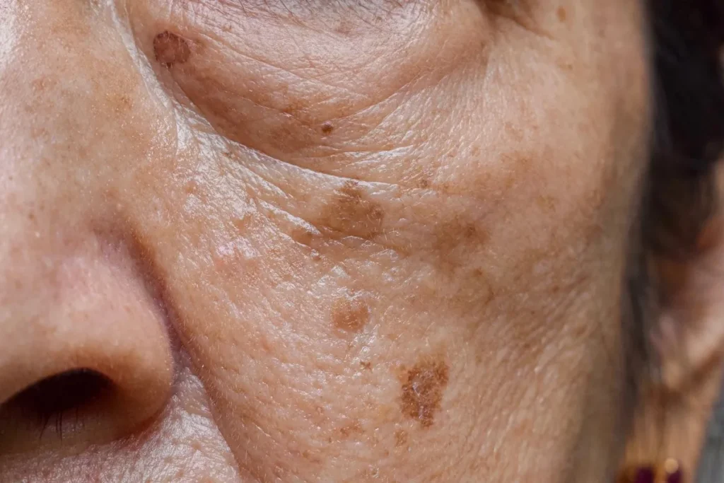 Old Age Spots: Scary Red Marks And Amazing Fixes