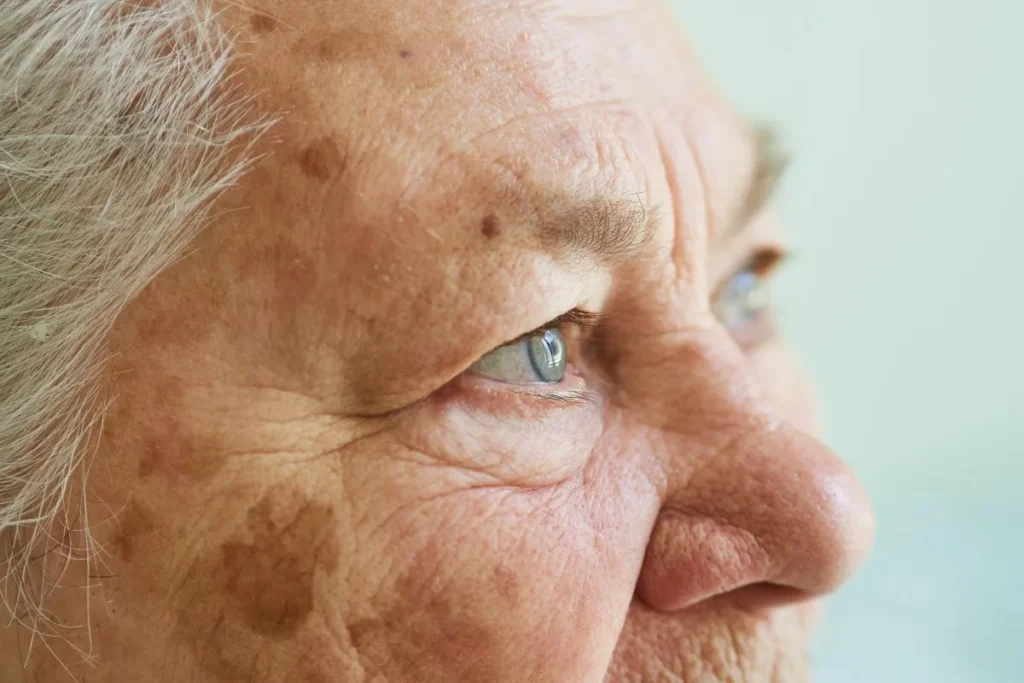 Old Age Spots: Scary Red Marks And Amazing Fixes