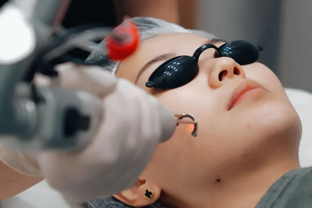 Skin Laser Treatment For Pigmentation: Best Fix