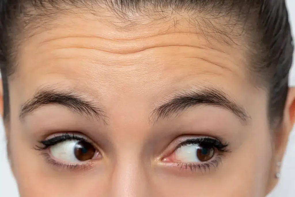 Understanding Frown Lines: Causes and Formation