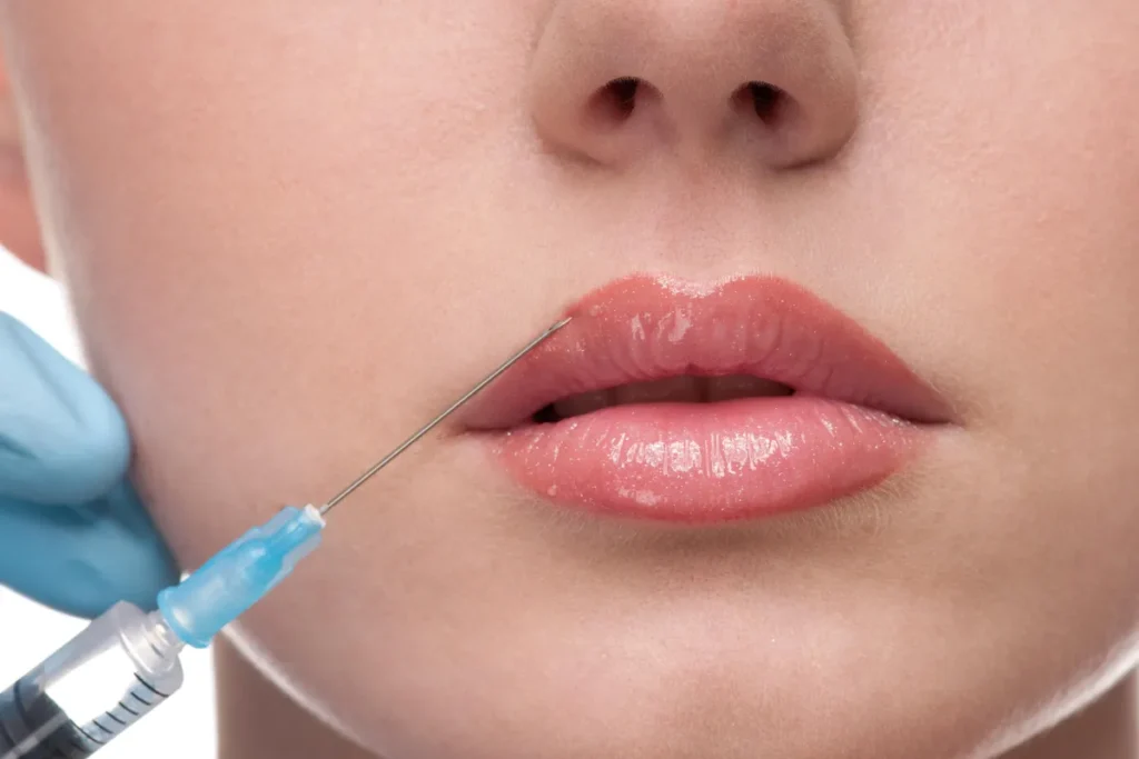 What Is a Botox Lip Flip?
