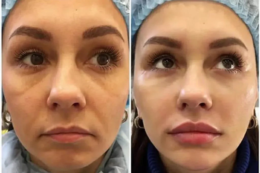 Full Face Filler Before And After: Amazing