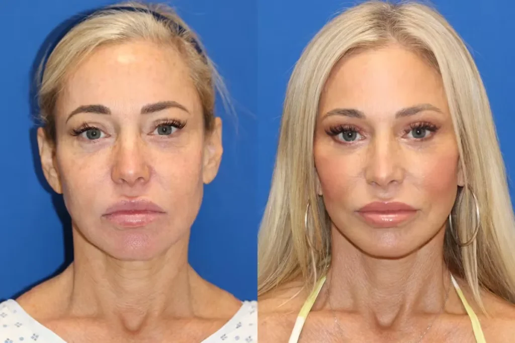 Full Face Filler Before And After: Amazing