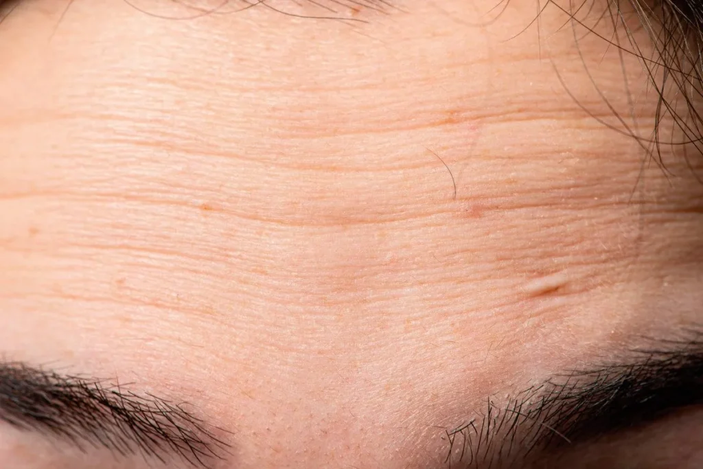 How To Avoid Forehead Wrinkles: Best Proven