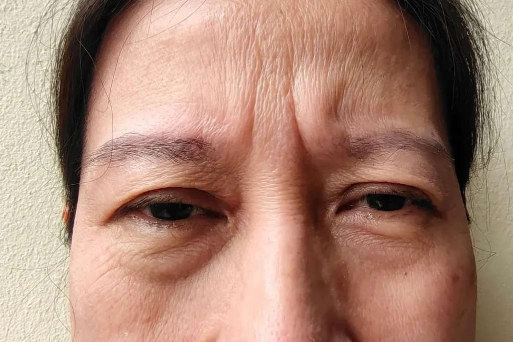 How To Avoid Forehead Wrinkles: Best Proven