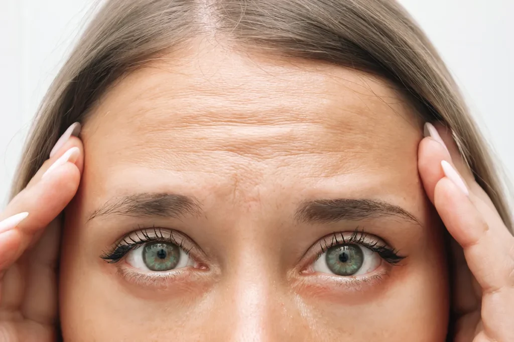 How To Reduce Forehead Lines: Amazing Fixes