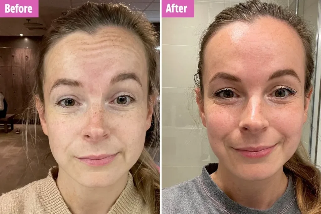 Where To Put Fillers: Powerful Anti-Aging Map