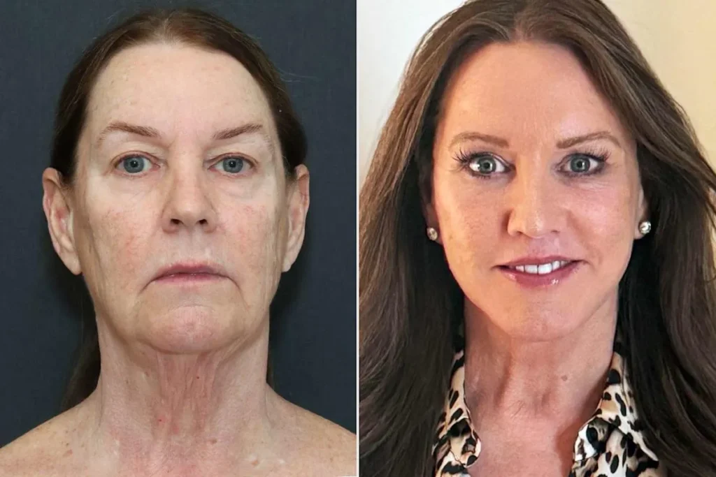 What Are Facial Fillers Made Of? Expert Insights