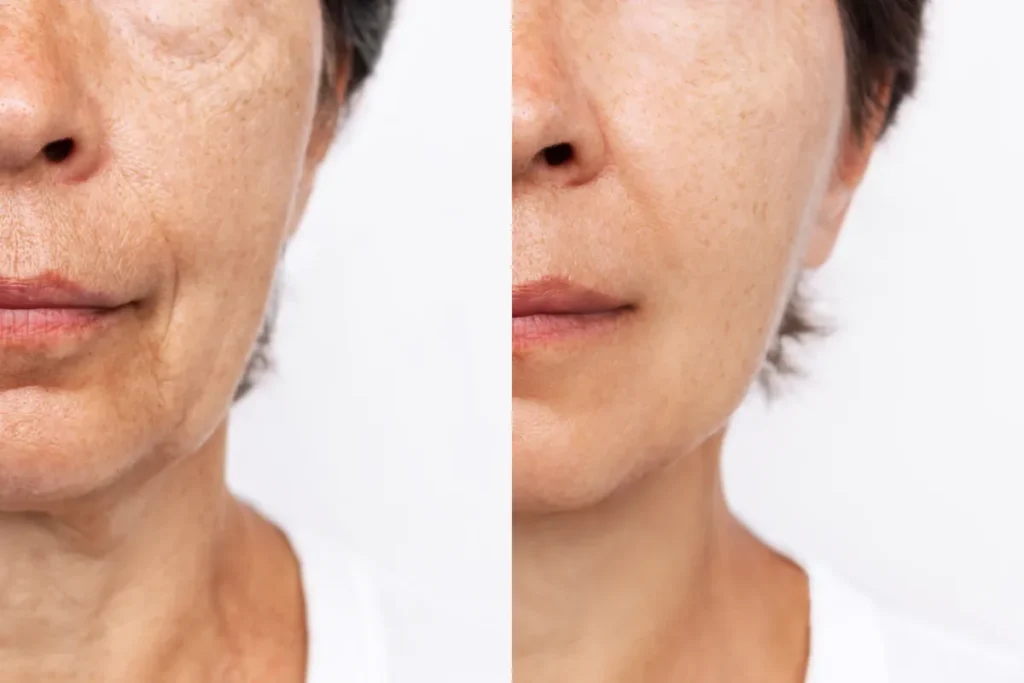 Old Woman Wrinkles: Proven Removal Tips