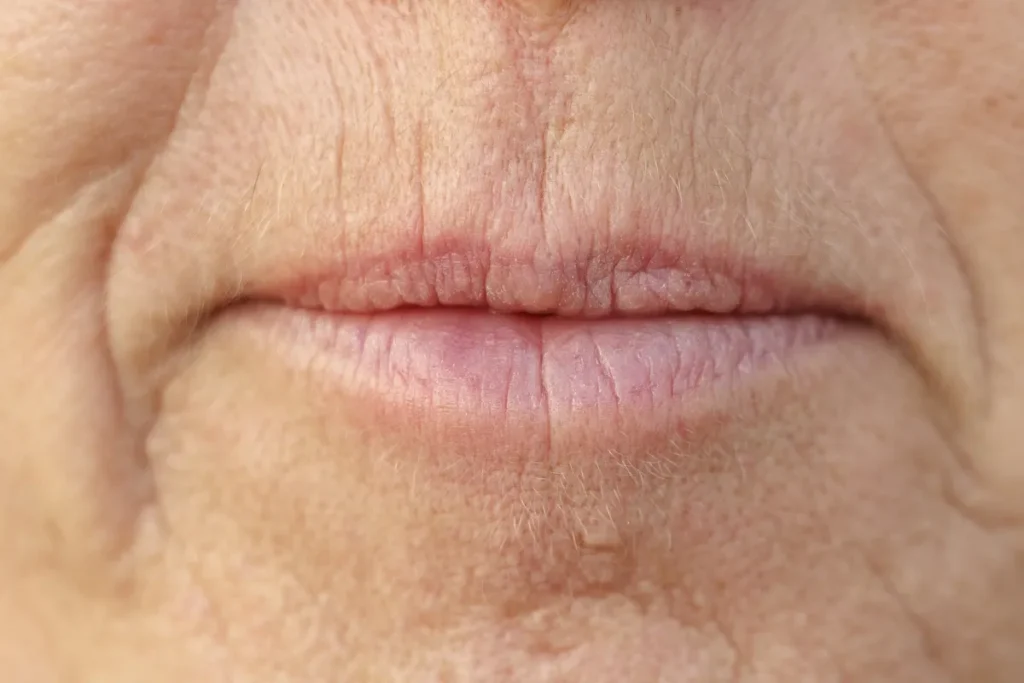 Upper Lip Line Filler: Erase Wrinkles