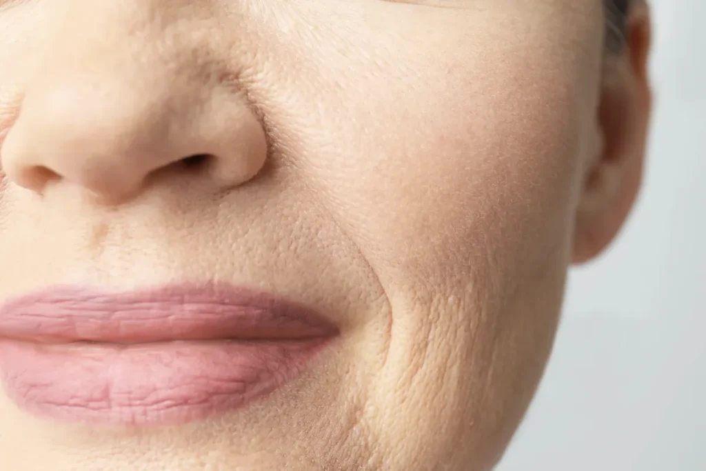 Upper Lip Line Filler: Erase Wrinkles